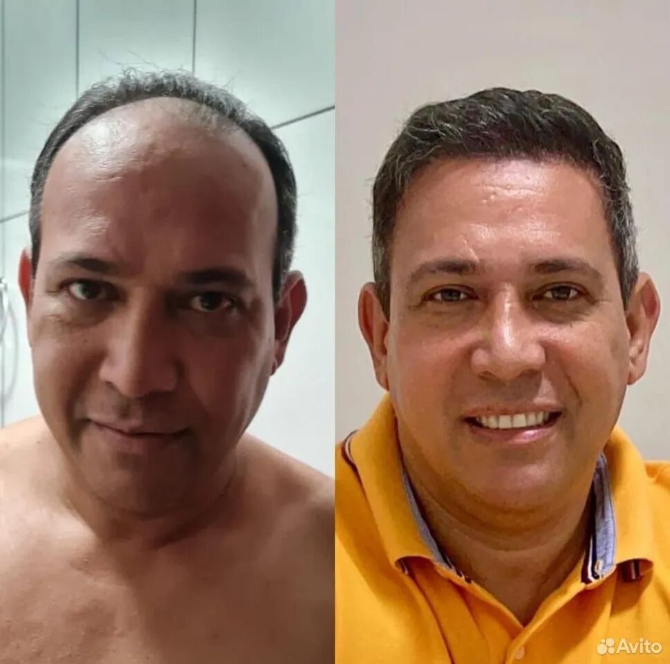 пересадка волос в Москве