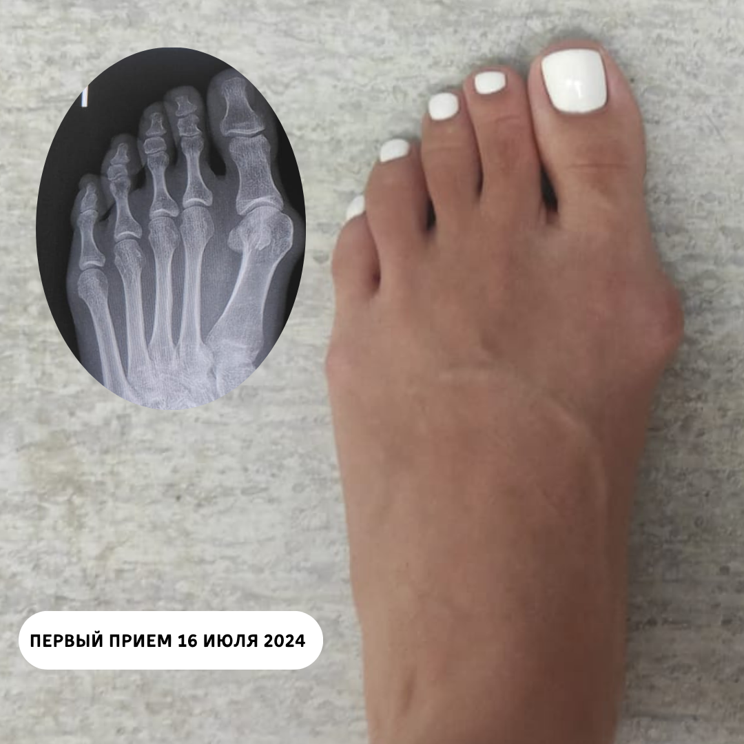 Первый прием