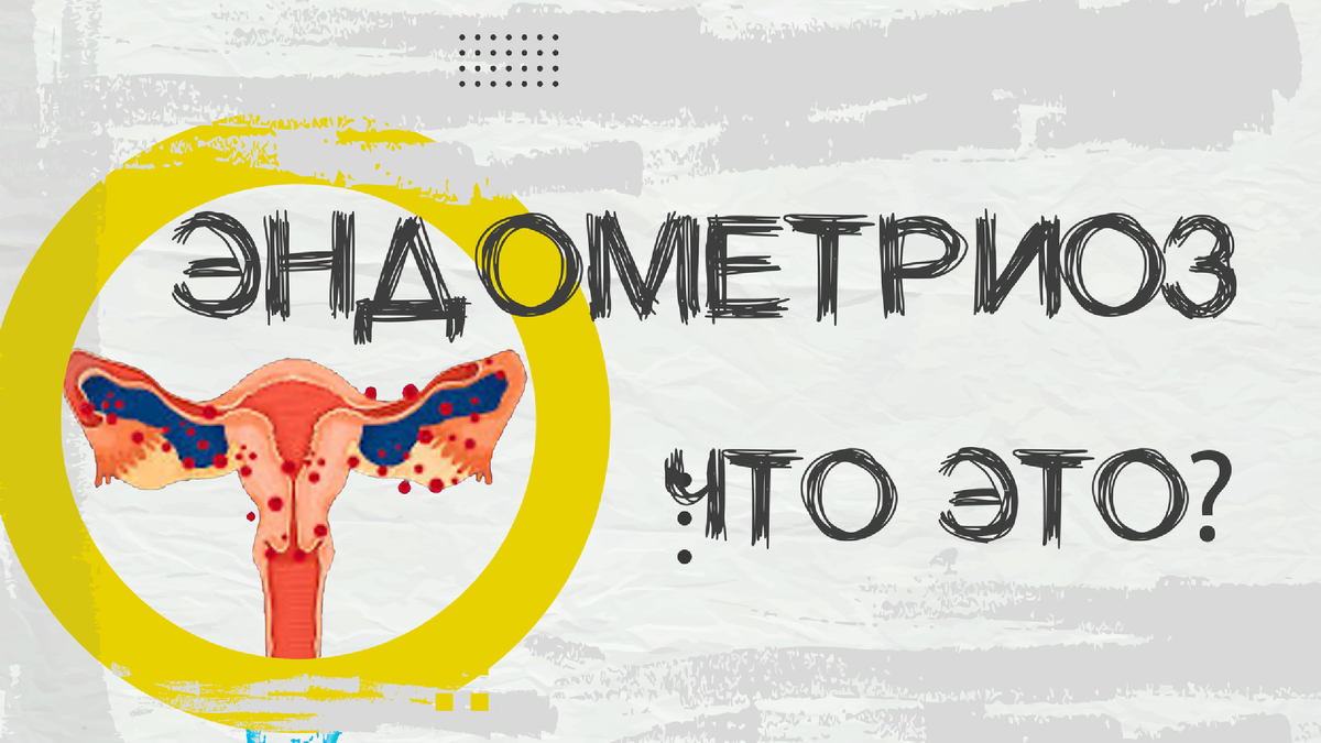 Ответы на вопросы про эндометриоз