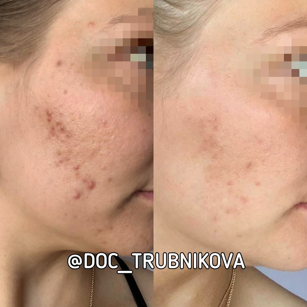 Текстура кожи стала в разы лучше, высыпания почти исчезли 🥳