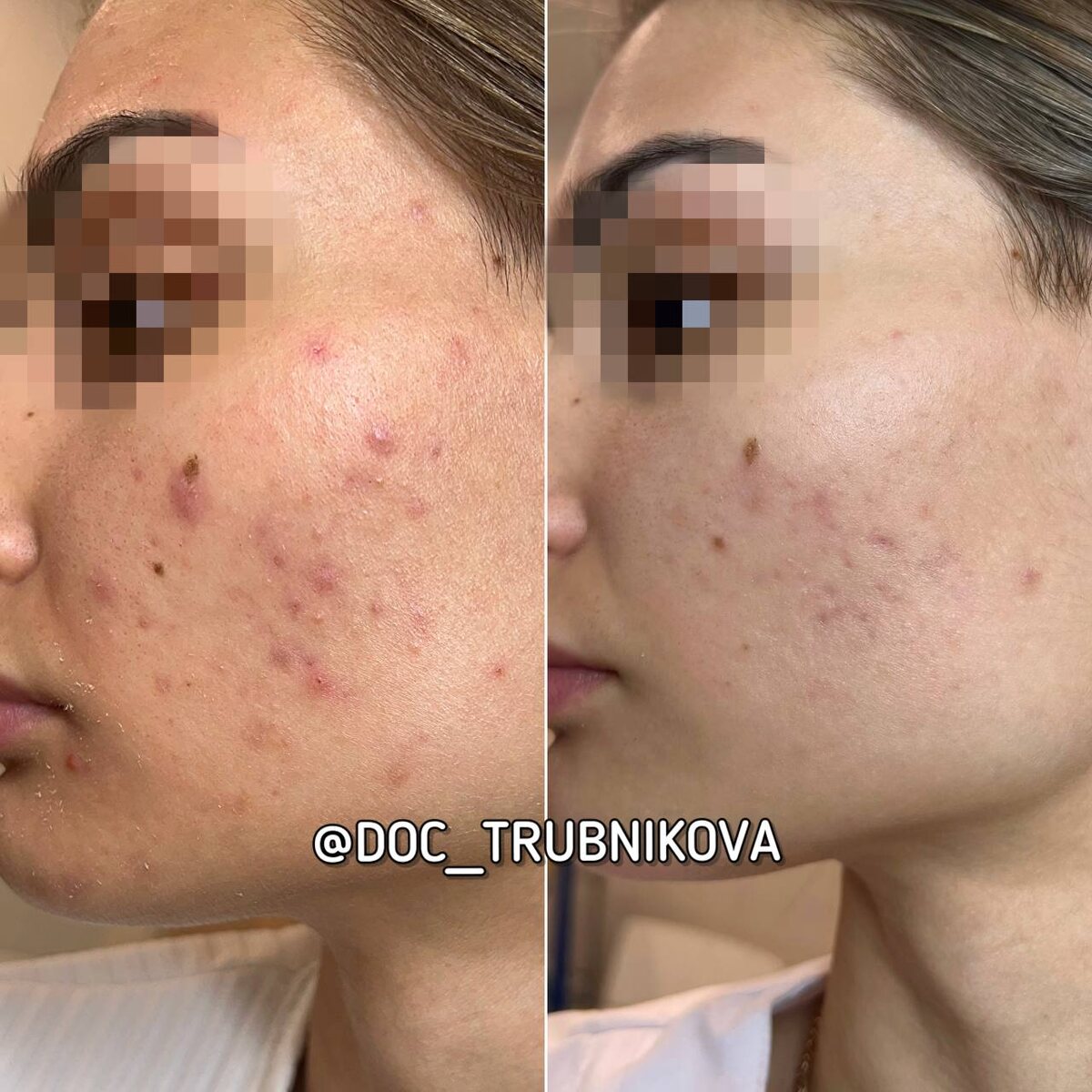 Впереди - борьба с пост-акне, но новых акне-элементов уже нет 🥳