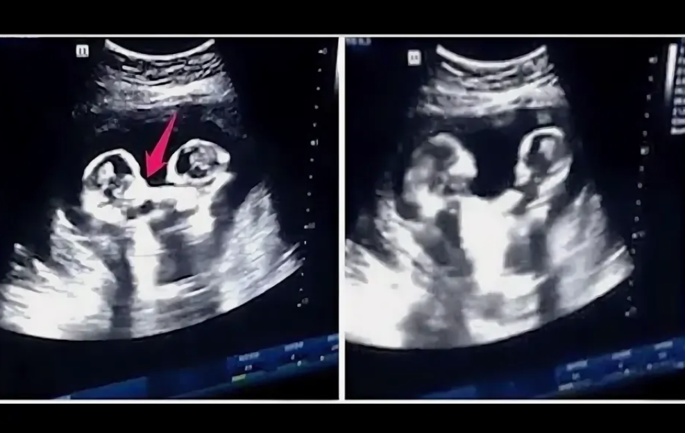 УЗИ с близнецами. Фото из интернета