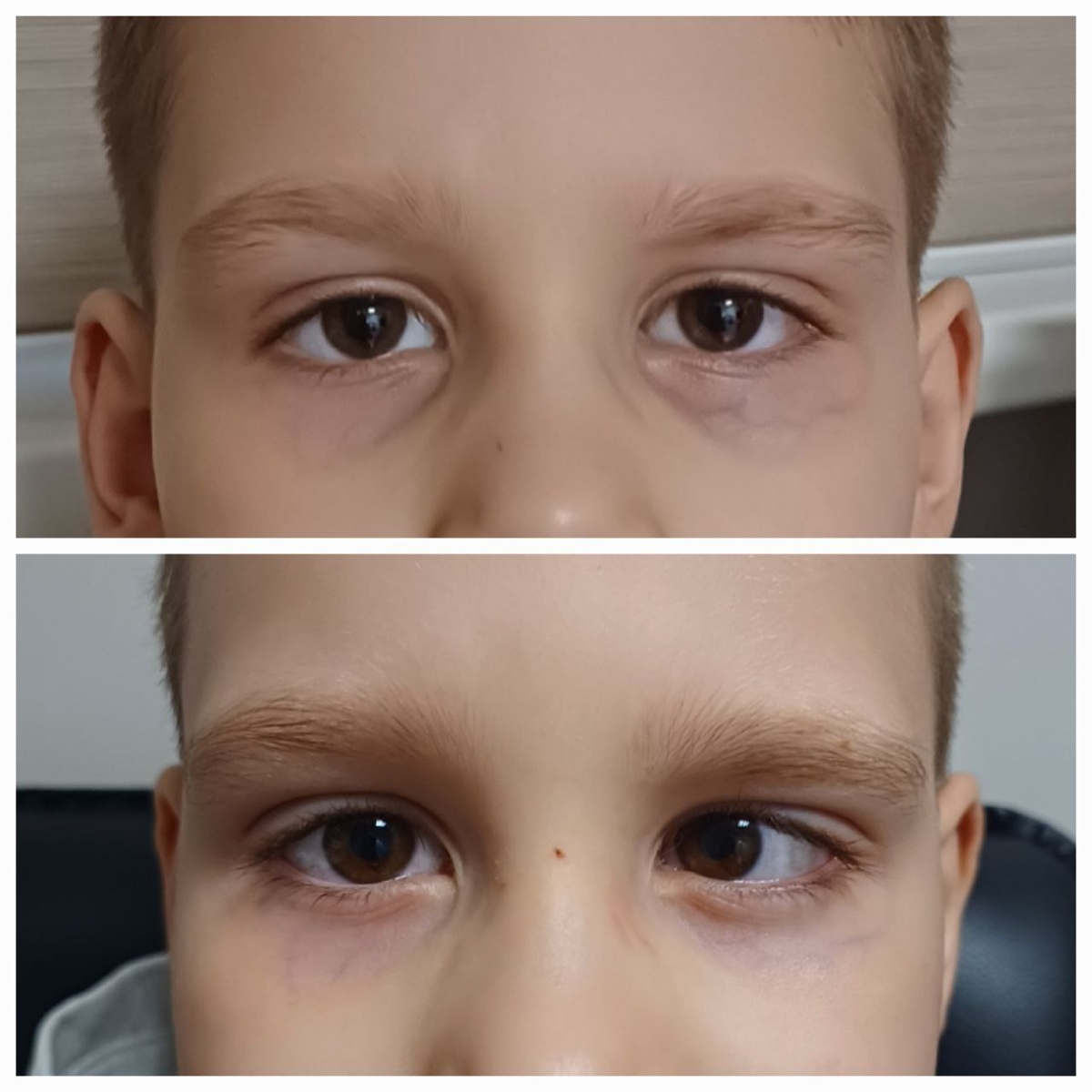 Ребенок до операции и после операции