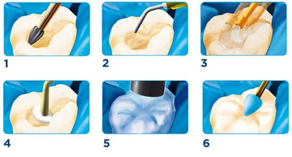 Реставрация зубов световыми пломбами