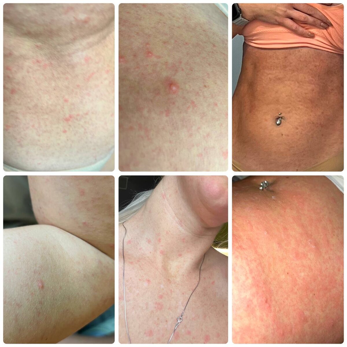 Вот так выглядела сыпь на 1 день высыпания. Красота, правда?