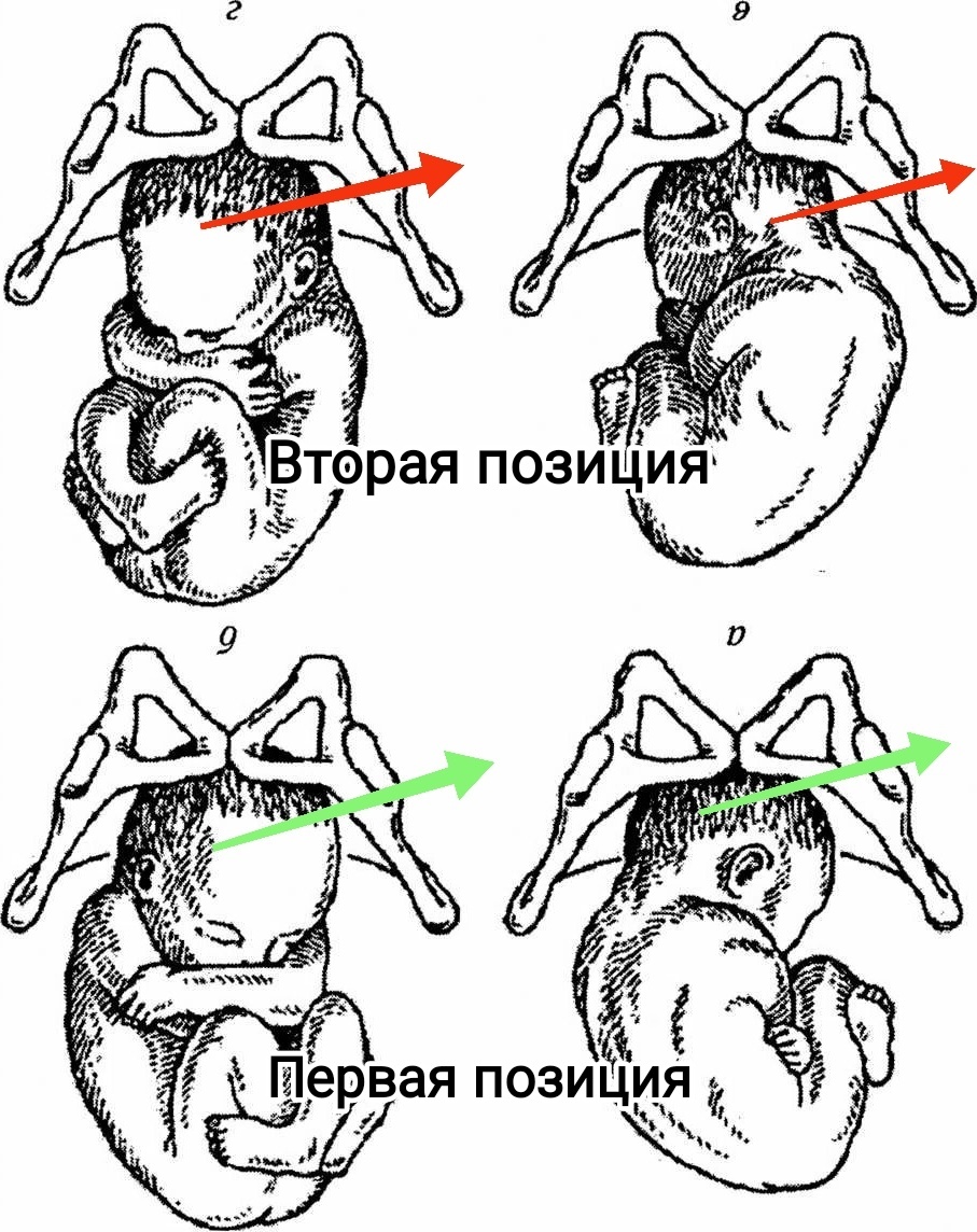 Рис.1 Поворот головки плода в первой и во второй позициях.