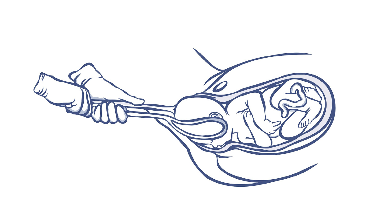 Рис.2  Извлечение плода щипцами