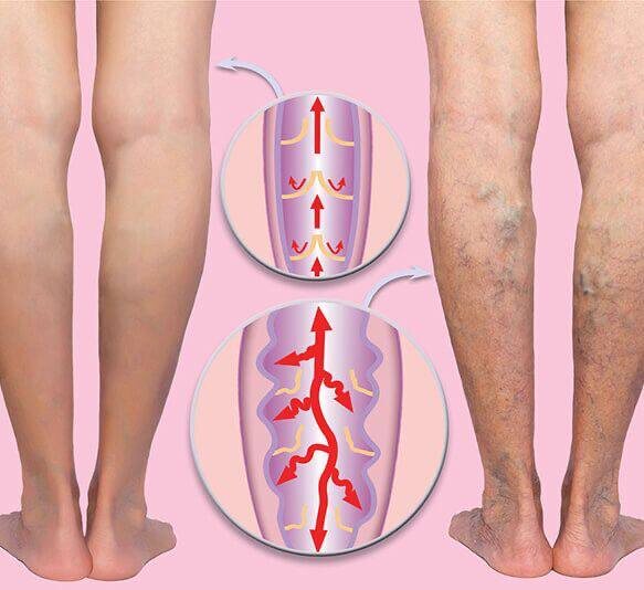 Разница между зоровыми венами и венами, пораженными варикозным расширением
