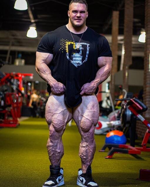 Пример варикозного расширения вен нижних конечностей у бодибилдера