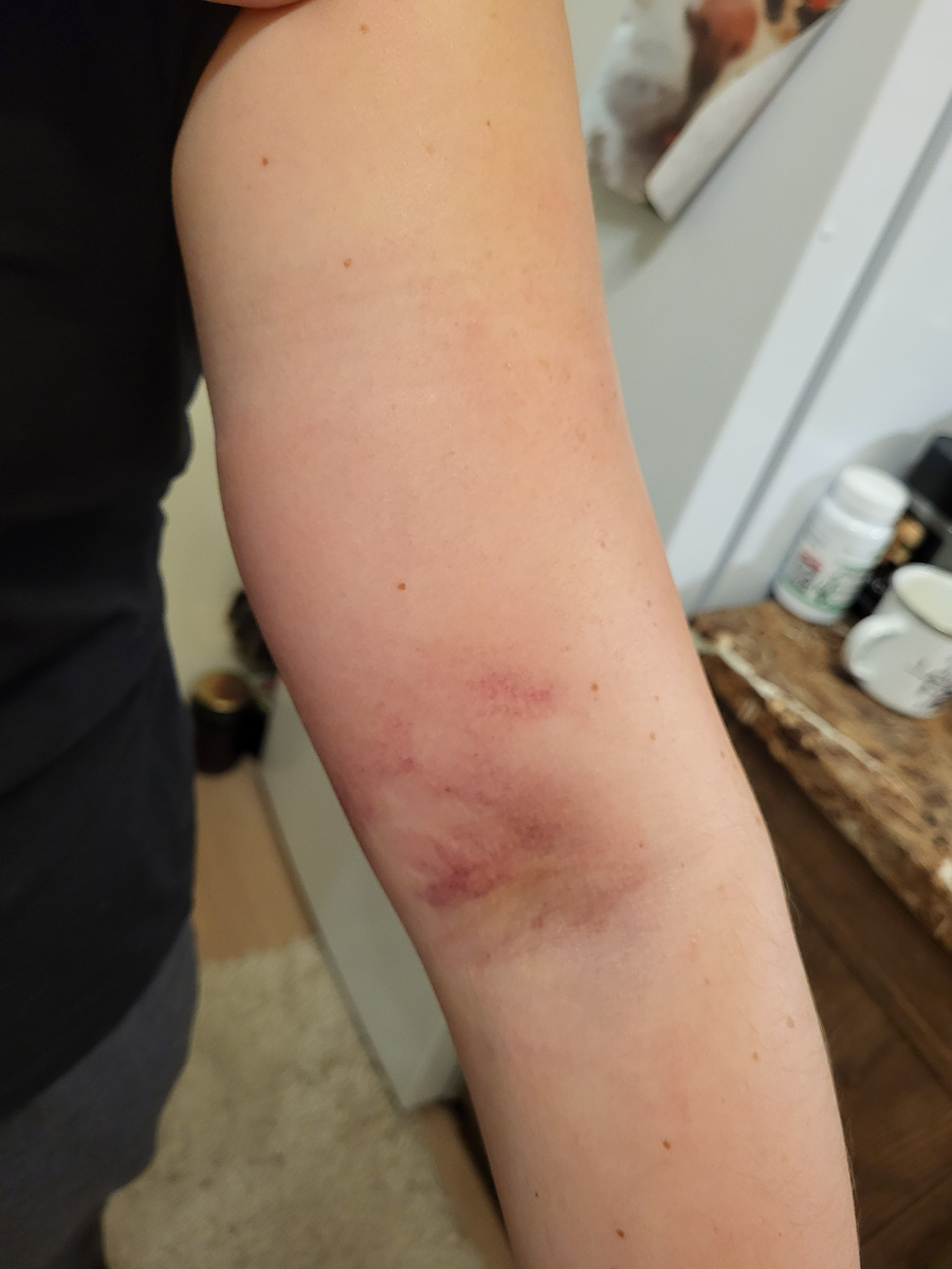 Так выглядела моя рука на второй день