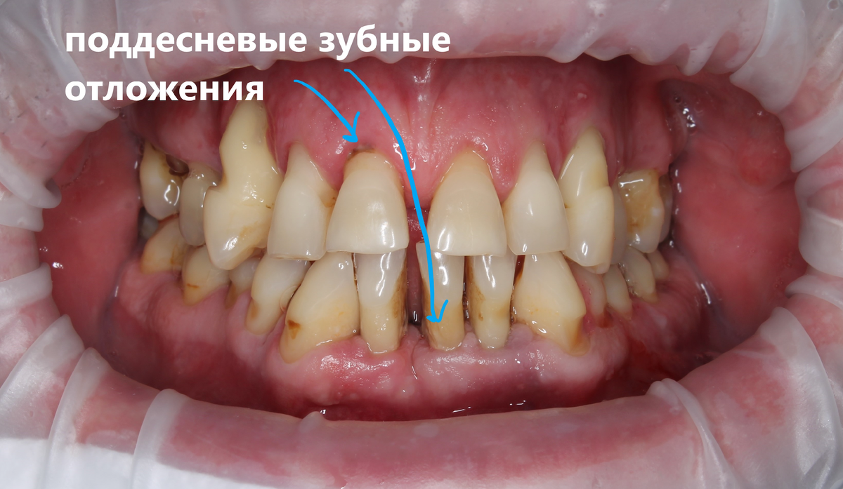 Тяжёлая степень тяжести хронического генерализованного пародонтита + перегрузка 