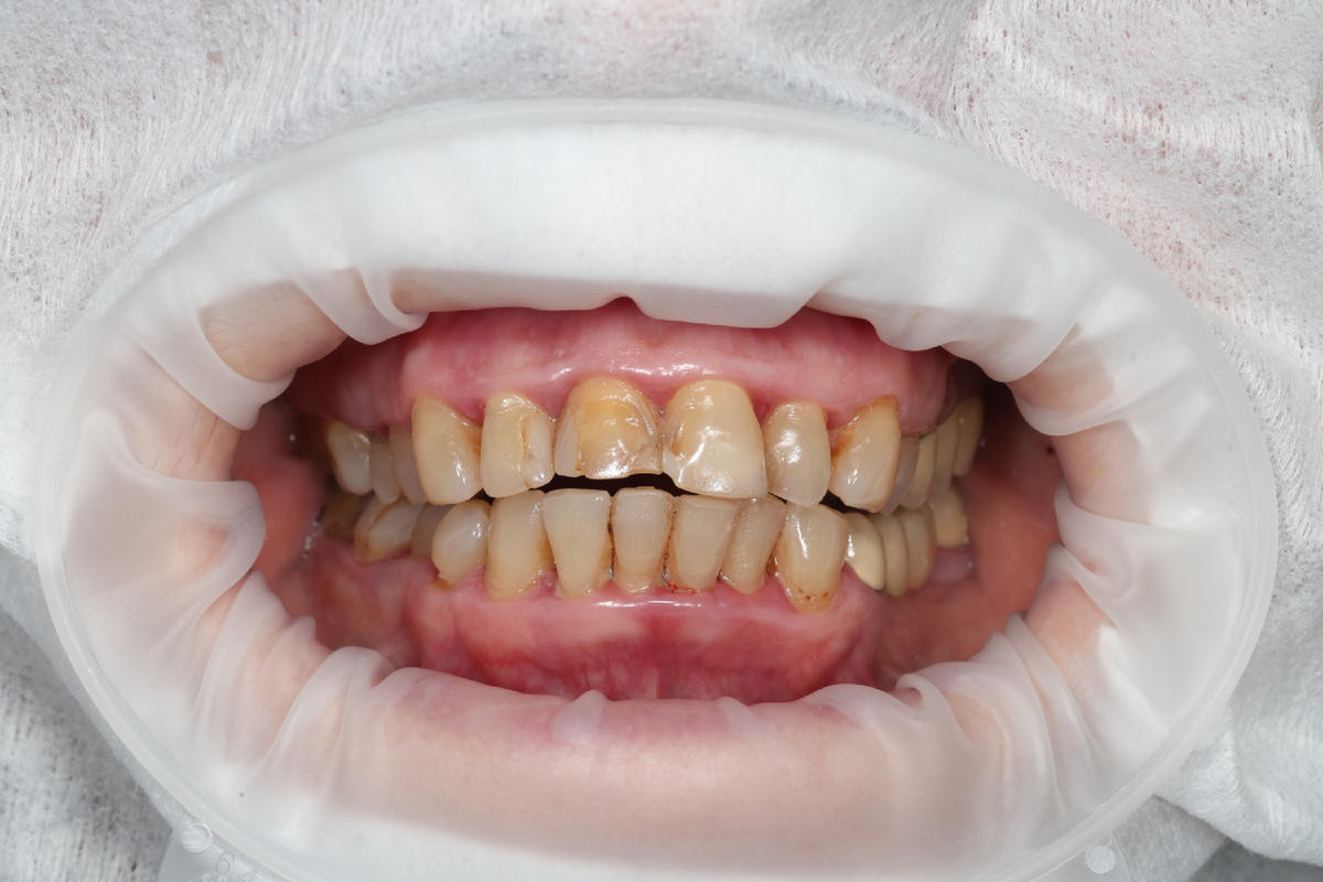 Тяжёлая степень тяжести хронического генерализованного пародонтита 