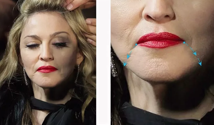 Опущенные углы рта или "улыбка Пьеро"