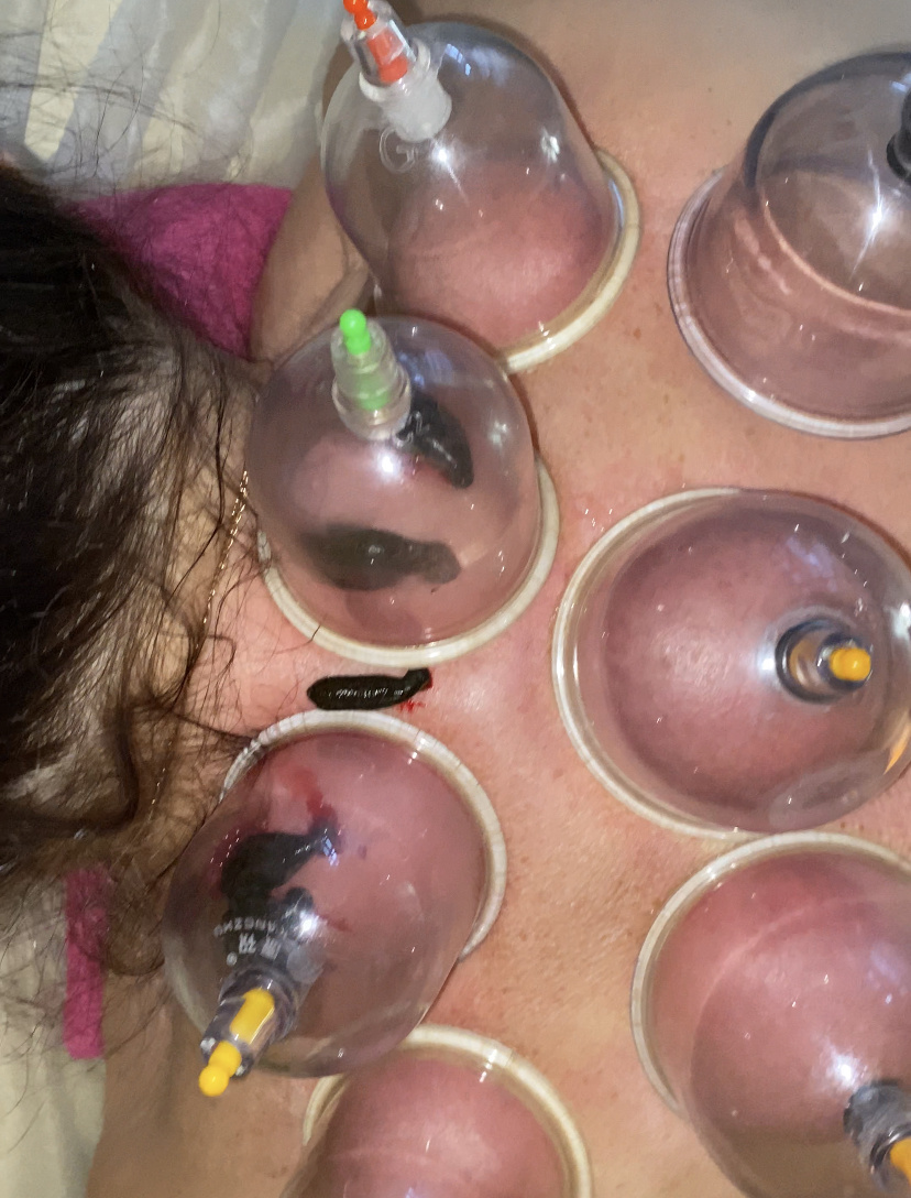 Вакуум + пиявки улучшат кровообращение и дренаж, разобьют жировые отложения, вернут подвижность шее. Фото - собственность автора статьи