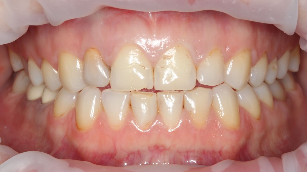 Зубы Оксаны до лечения