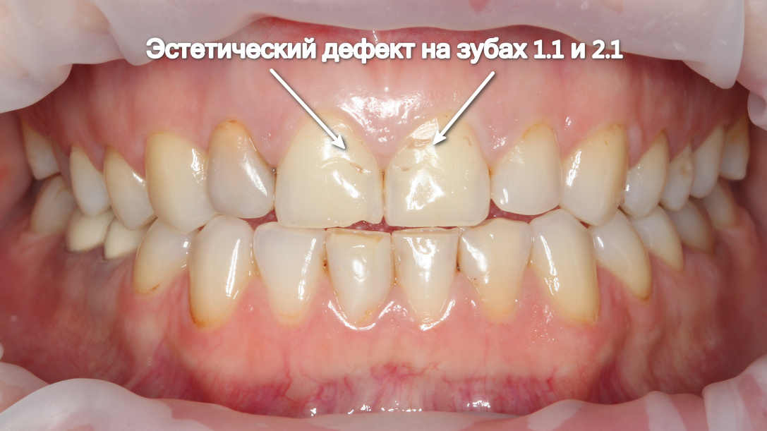 Дефект на зубах 1.1 и 2.1