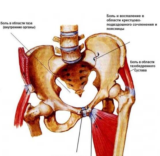 К чему ведет перекос таза и что с этим делать?
