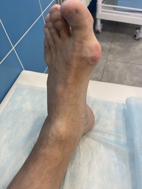 Подагра. Состояние ступни до начала лечения.