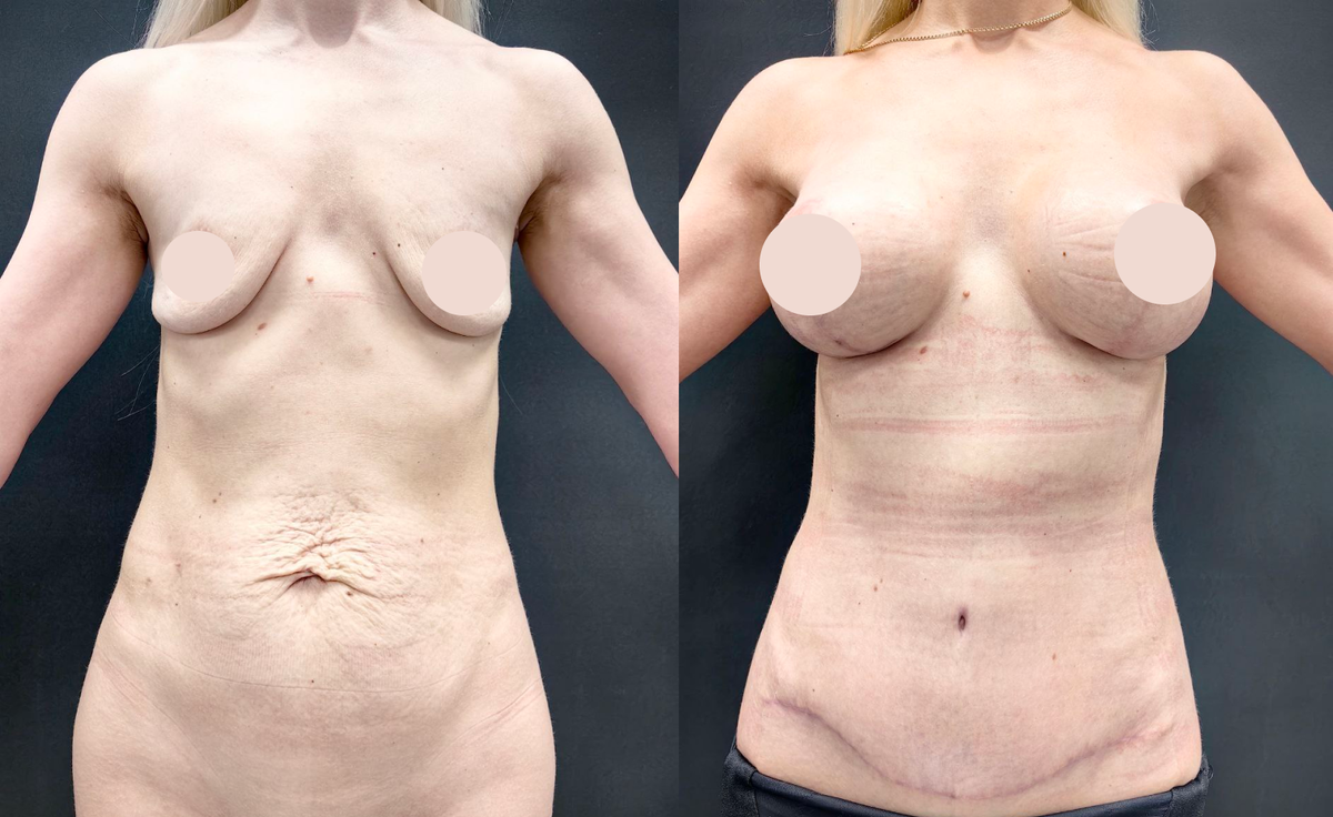 Абдоминопластика и увеличение груди с подтяжкой.