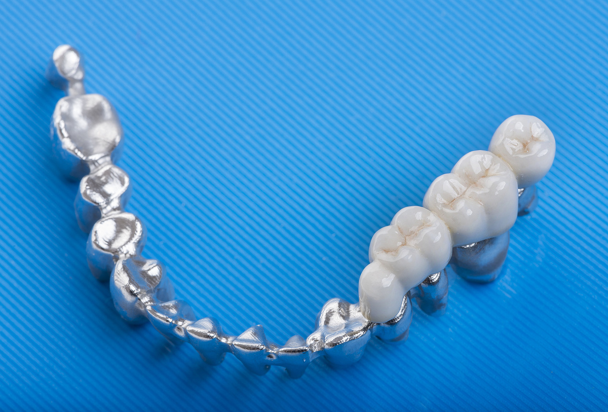 Мостовидный протез