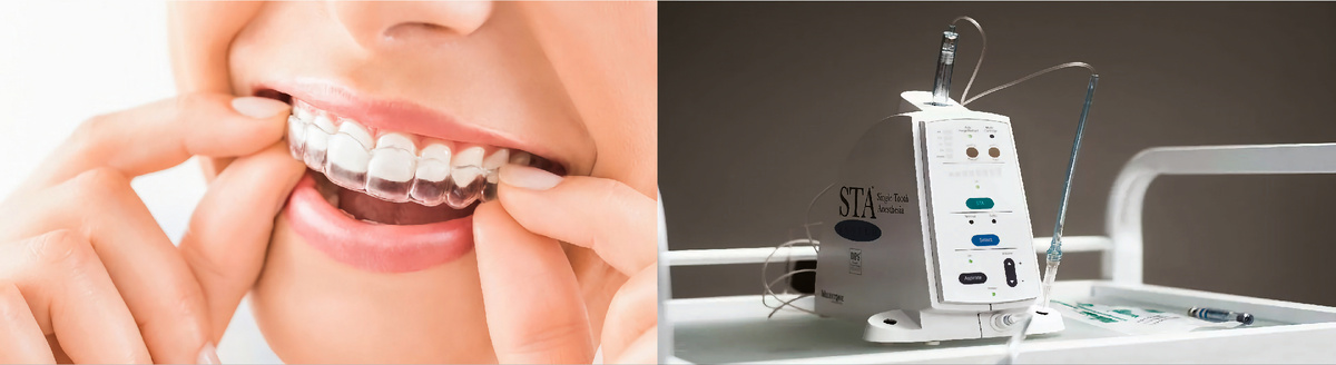 Invisalign и анестезия STA