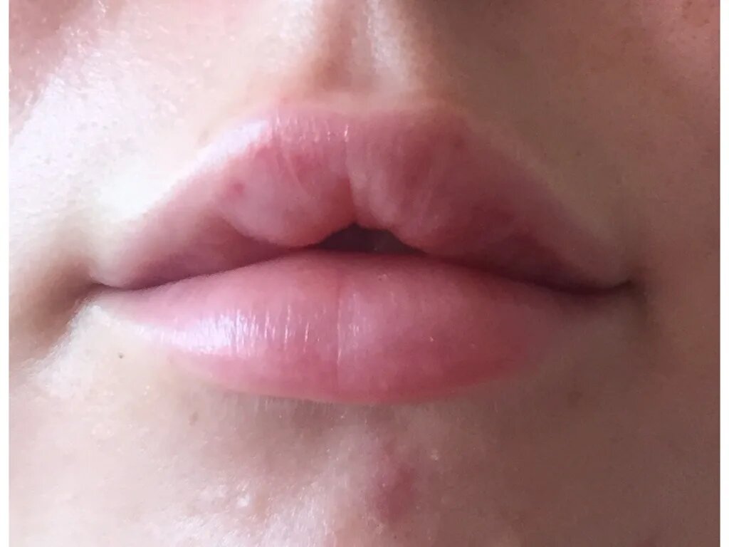 "Комки" в губах после введения филлера