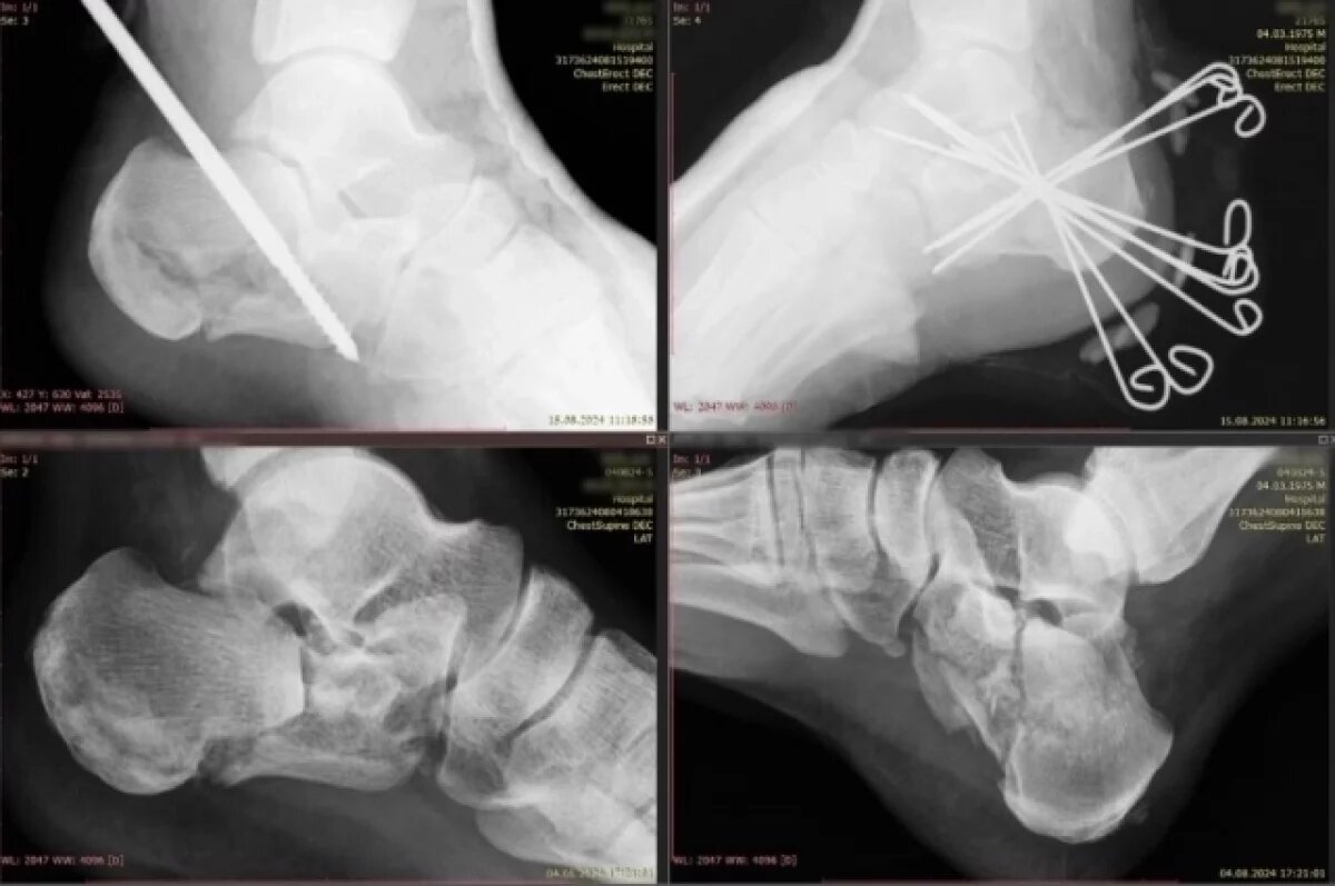    Врачи вернули уральцу возможность ходить после сложной травмы