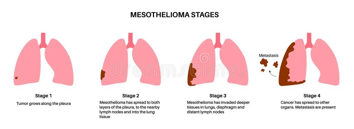 Стадии мезотелиомы плевры схематично. Изображение из открытых источников. 