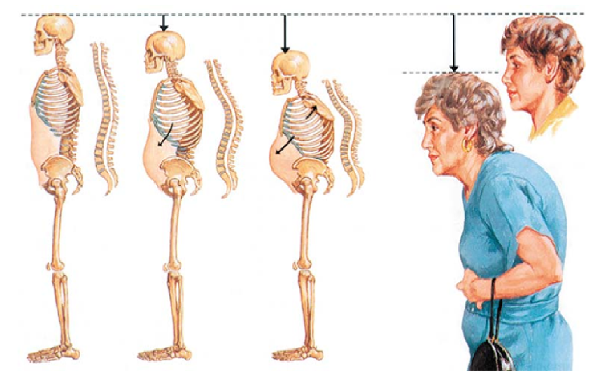 Изменение роста и осанки при остеопорозе