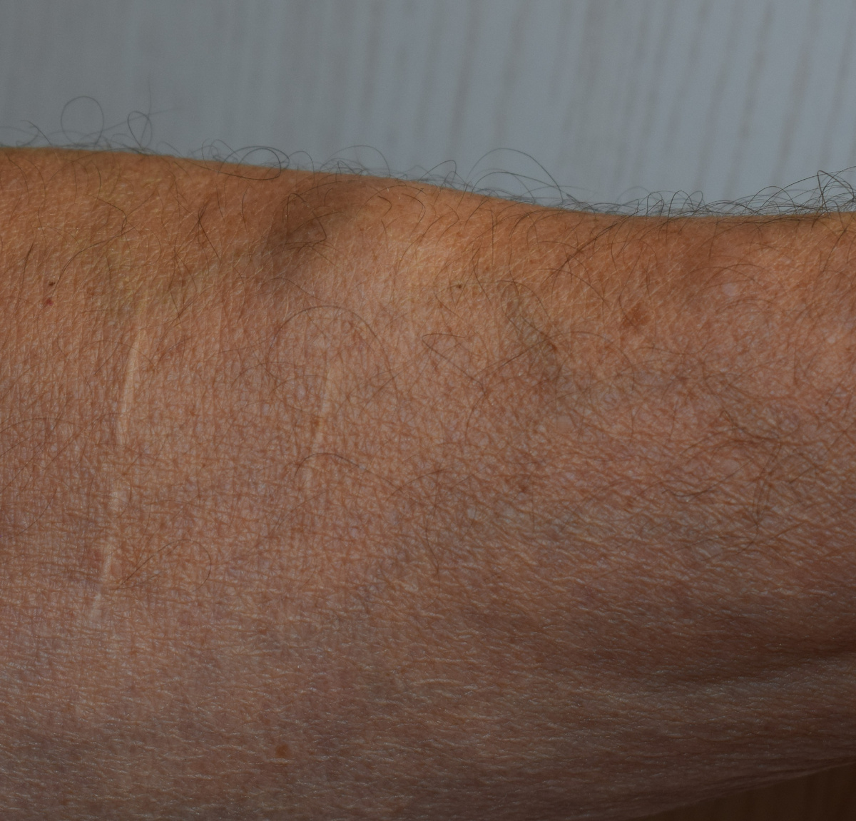 жировик на руке(фото автора)