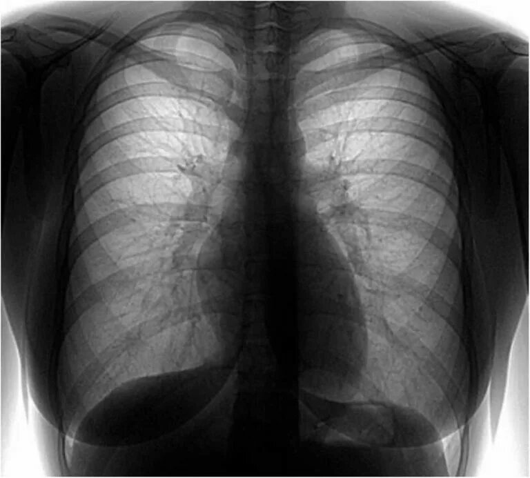 Флюорография (часто в позитиве)