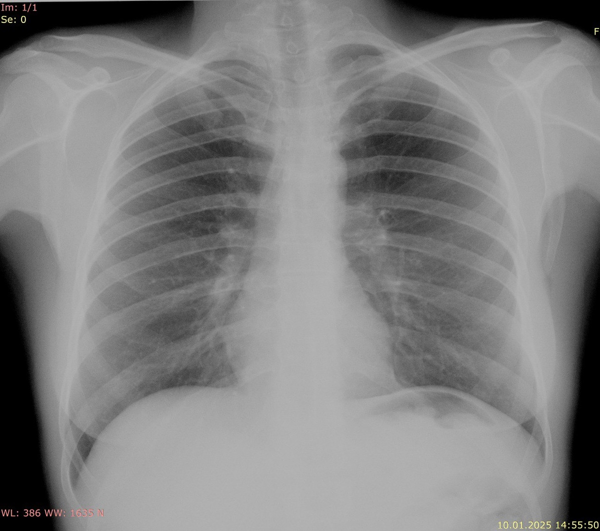 Рентгенография (в негативе)