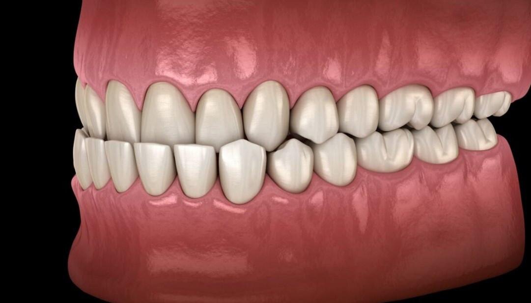 Мезиальный прикус