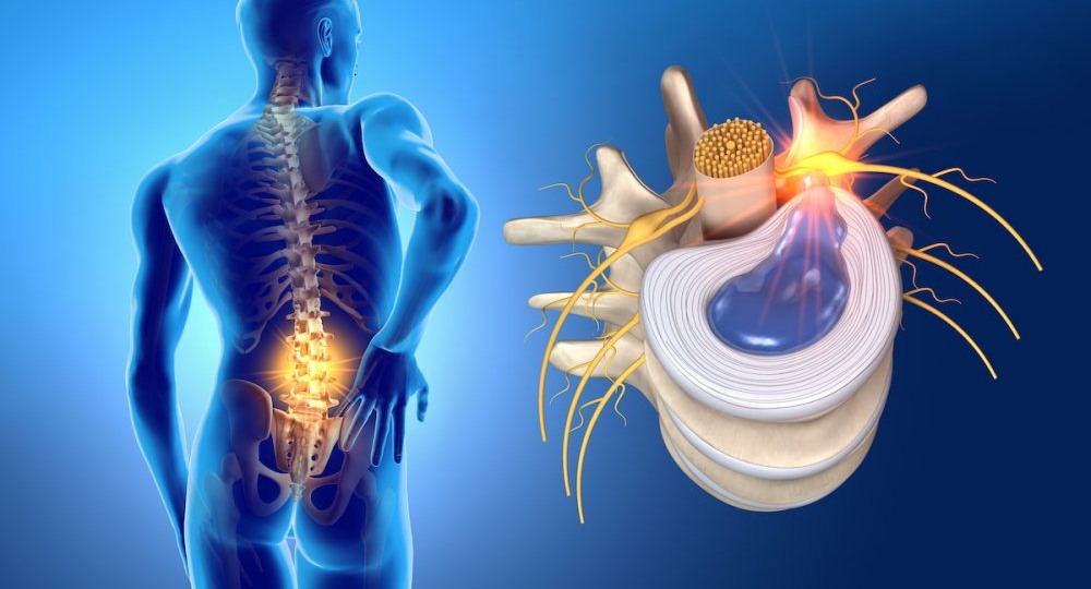 Грыжа поясничного отдела – распространенная причина боли в пояснице и самая частая форма межпозвоночных грыж.