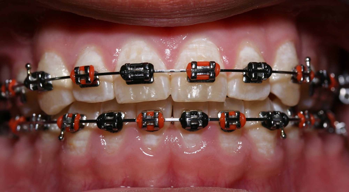 Металлические лигатурные брекеты.