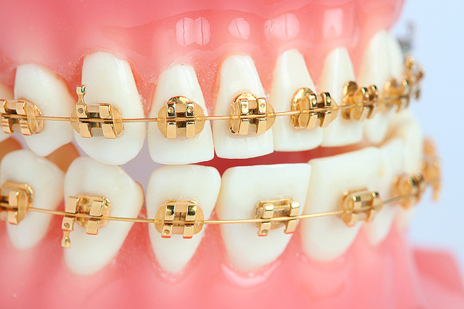 Брекеты с позолотой.