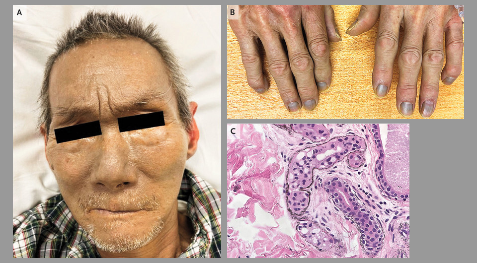   Tin Yan Lee, and Wan Hang Lau / NEJM, 2025