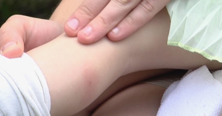 Ukusy klopov na tele foto