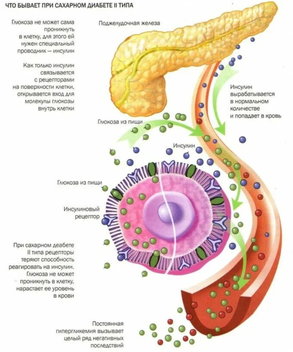 Сахарный диабет ll типа.