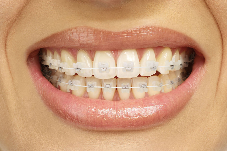 Керамические безлигатурные брекеты.