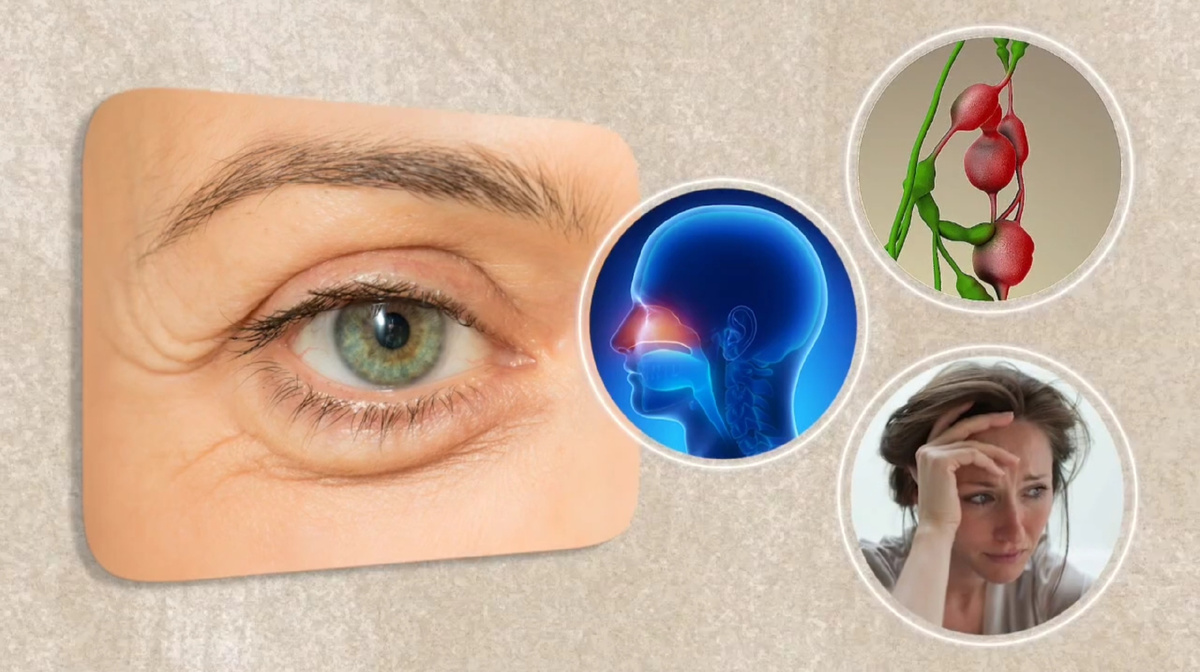 Причины мешков под глазами - застой лимфы, воспалительные процессы по гайморовым пазухам и полости носа и с эмоциональные переживания