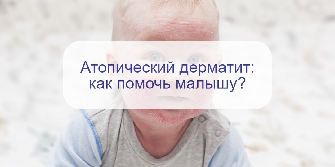 Все, что родители хотели бы спросить про атопический дерматит – причины, проявления и уход