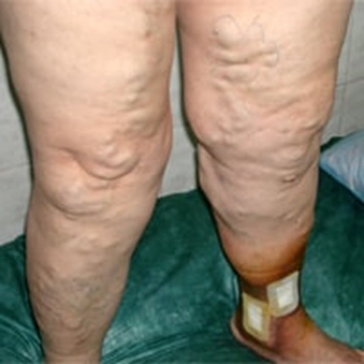 Варикозная болезнь нижних конечностей