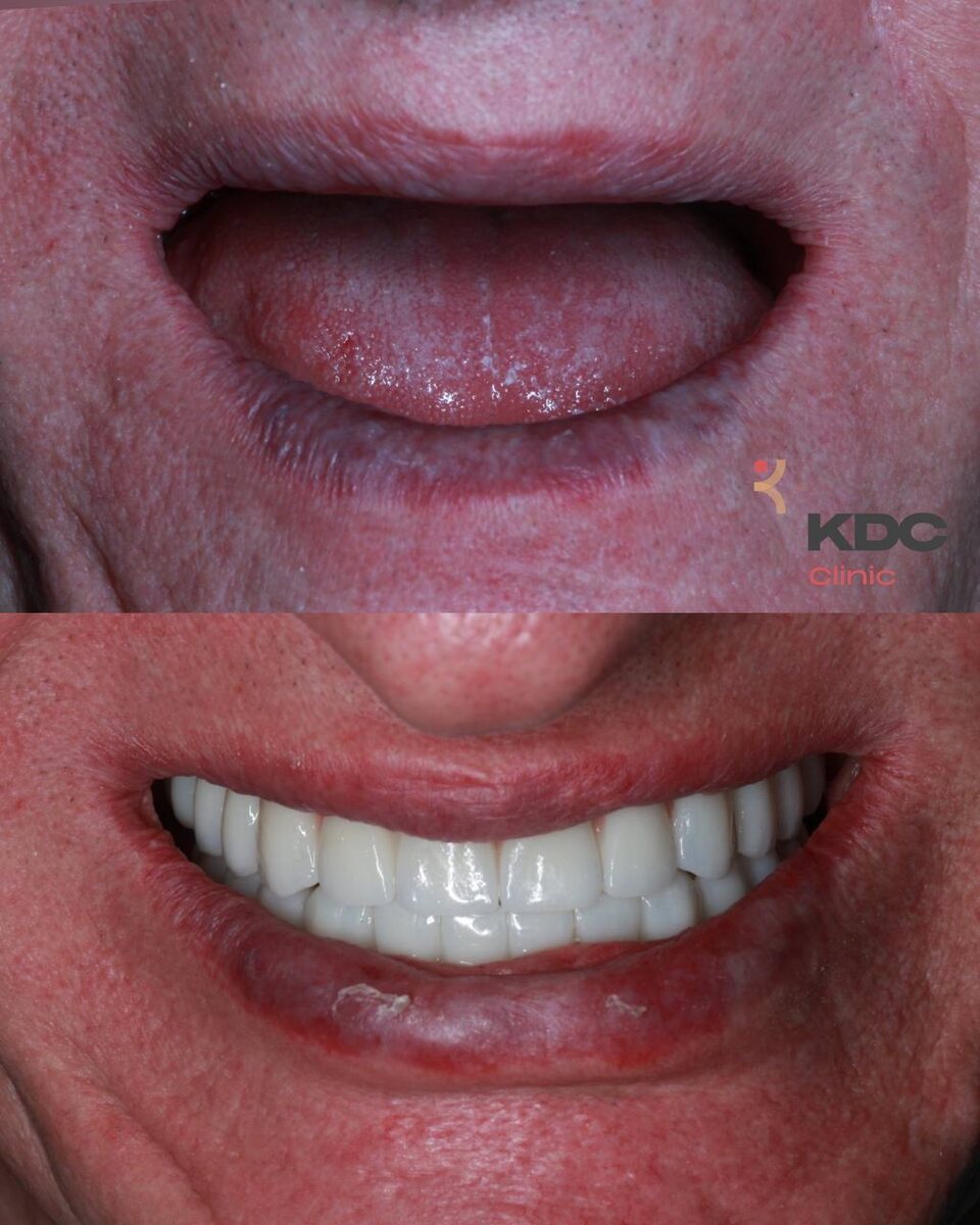 На фото вы видите зубы до и зубы после имплантации, как на верхней, так и на нижней челюстях. Выполнен временный несъёмный металлоакриловый протез на винтовой фиксации. Через 6 месяцев временный протез будет заменён на постоянный.