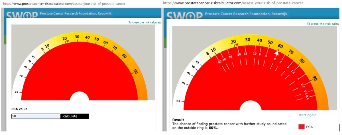 Калькулятор 2.  Вериятность наличия РПЖ при ПСА 20 нг/мл