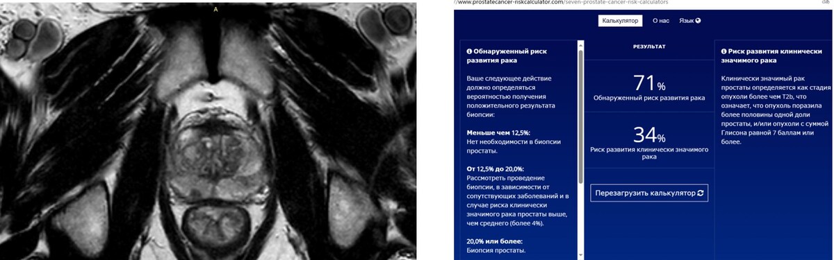 МРТ предстательной железы (опухоль правой доли) и калькулятор риска 3-4