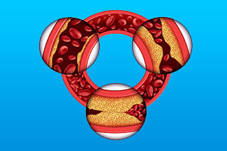 болезни сердца;