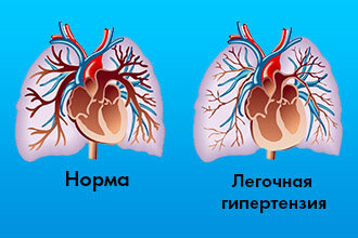 гипертензия;