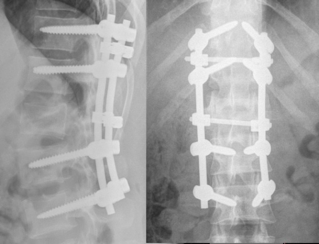     Мужчина после катания на тюбинге попал в красноярскую больницу с переломом позвоночника