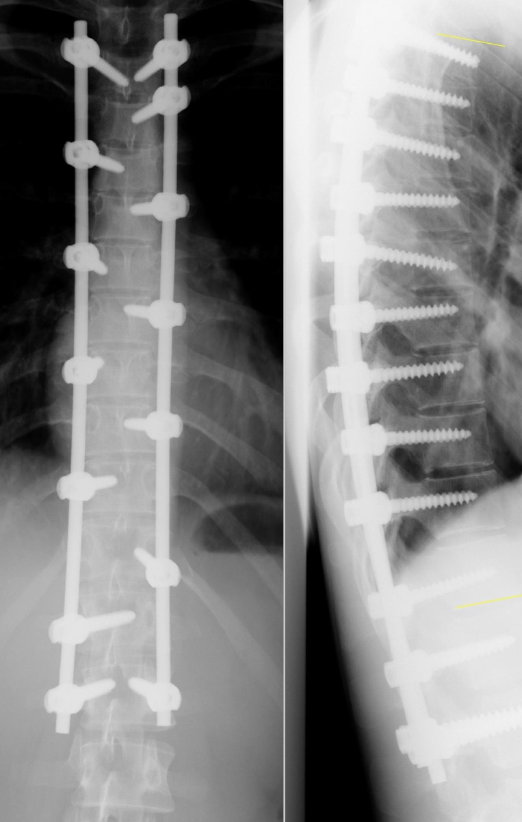 Личный Rg-снимок позвоночника автора канала в прямой и боковой проекции после оперативного лечения сколиоза